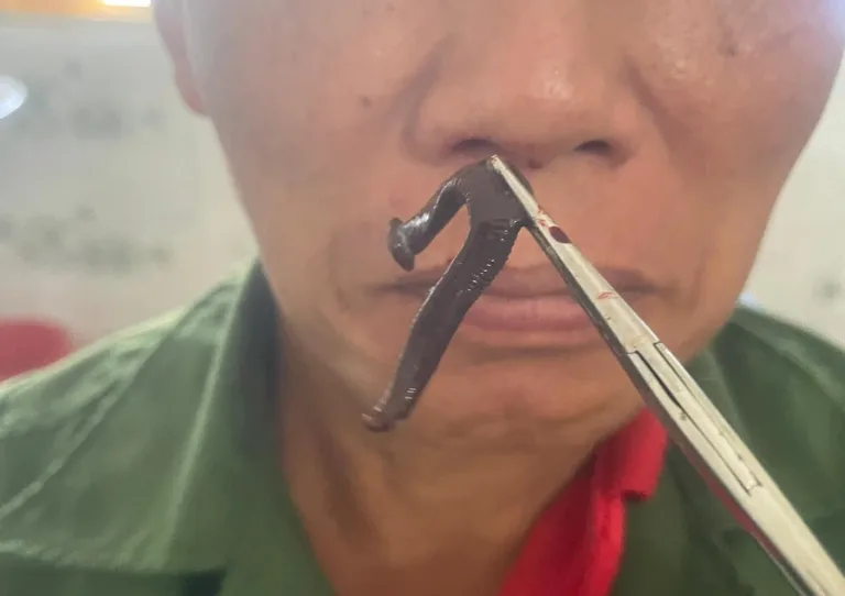 Gắp con đỉa còn sống trong khe mũi người đàn ông