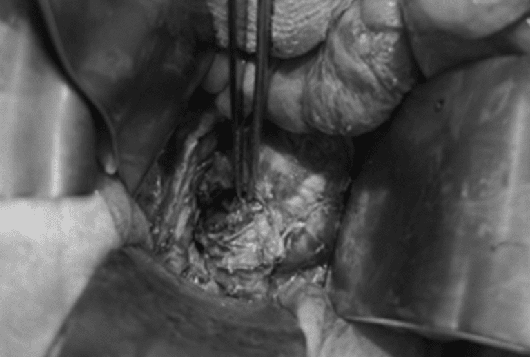 Thủng trực tràng do thải độc bằng phương pháp thụt tháo cà phê