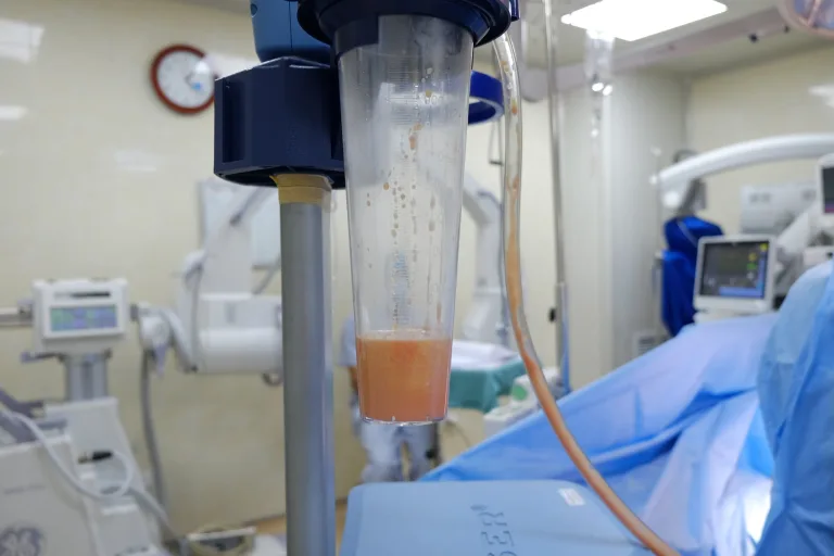 Các biến chứng nguy hiểm có thể gặp khi phẫu thuật hút mỡ