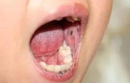 Hội chứng PEUTZ- JEGHERS và những điều cần biết