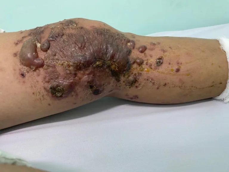 Nhập viện với nhiều nốt phỏng sau 1 tuần đắp thuốc lá