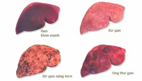 Liệu pháp miễn dịch thắp sáng hy vọng cho bệnh nhân ung thư gan