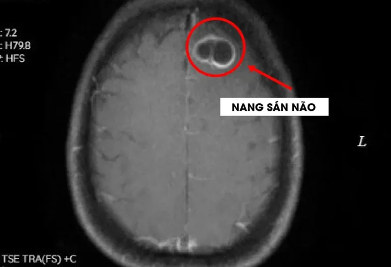 Phát hiện nang sán trong não do thói quen ăn tiết canh