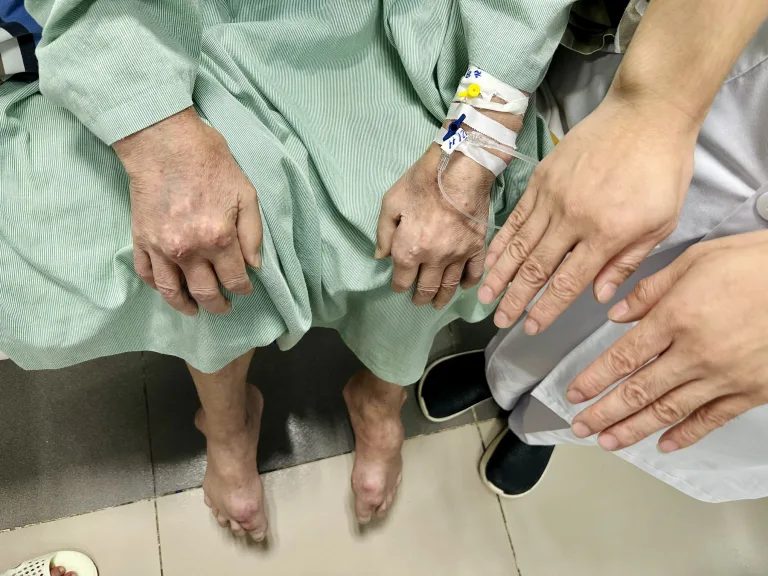 Cảnh báo tình trạng gout nặng do lạm dụng bia, rượu