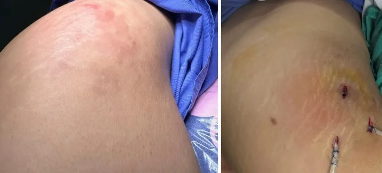 Người phụ nữ bị áp xe mông sau tiêm filler khắc phục hõm vòng 3