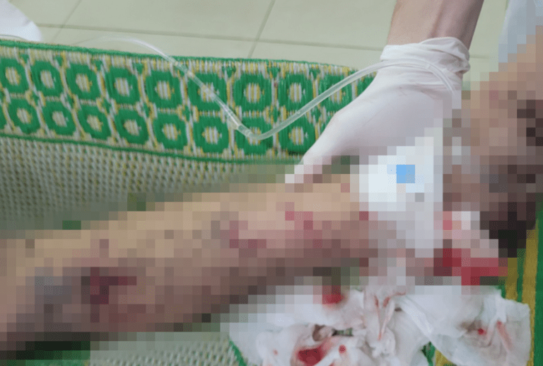Tay dập nát, nguy cơ mù mắt phải do pháo tự chế nổ