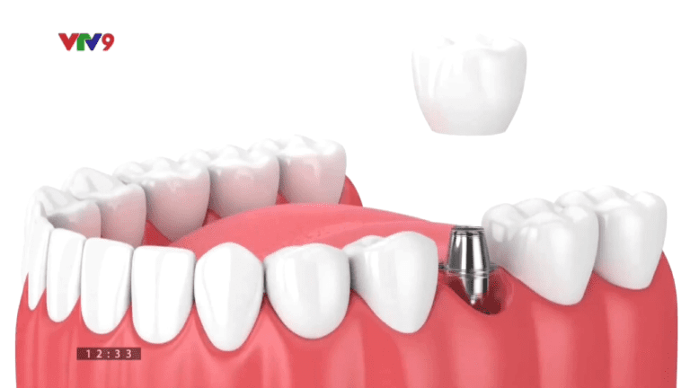 Cẩn trọng khi lựa chọn cơ sở cấy ghép Implant