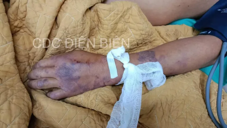 Điện Biên ghi nhận 1 trường hợp tử vong do mắc bệnh liên cầu lợn