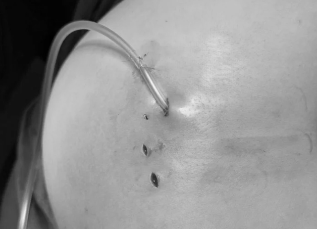 Tiêm filler chỗ “người quen”, người phụ nữ bị biến chứng nhập viện
