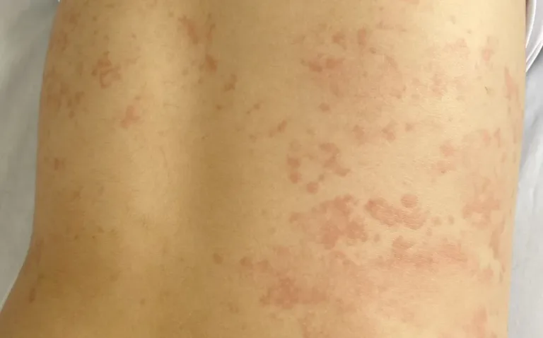 Bé trai bị phản vệ nghi do tiêm ngừa