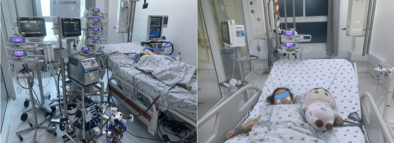 Can thiệp ECMO cứu bé gái mắc cúm A/H1 nặng